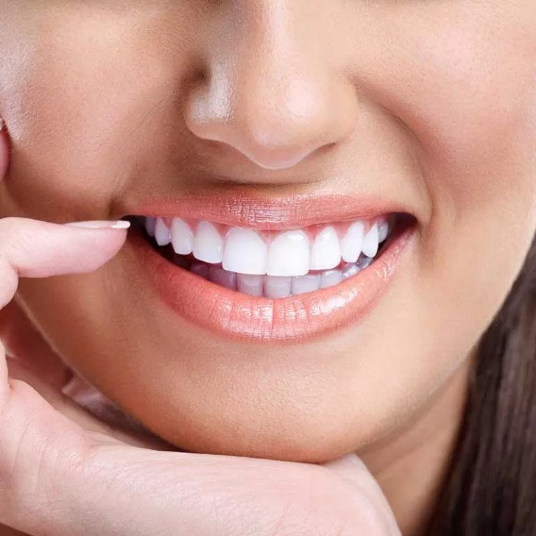 Dental Veneers Services